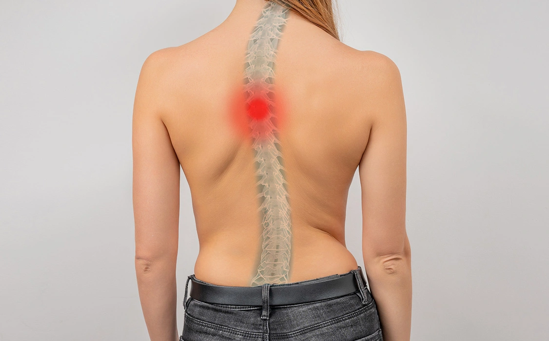 What is Kyphosis