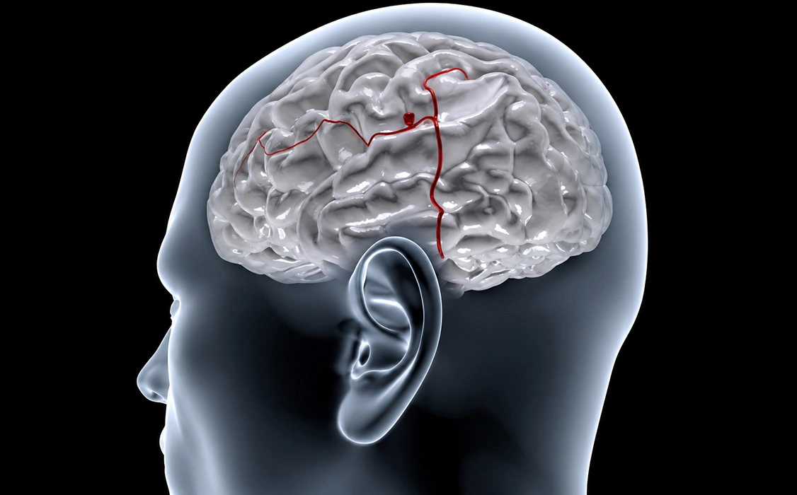 What is a Brain Aneurysm