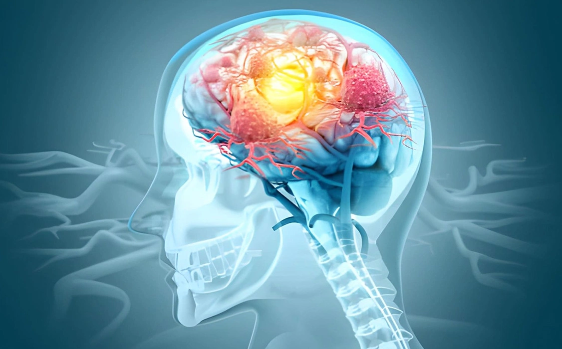 What is Epilepsy