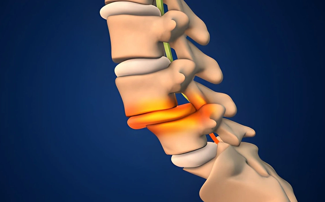 What is Endoscopic Disc Surgery